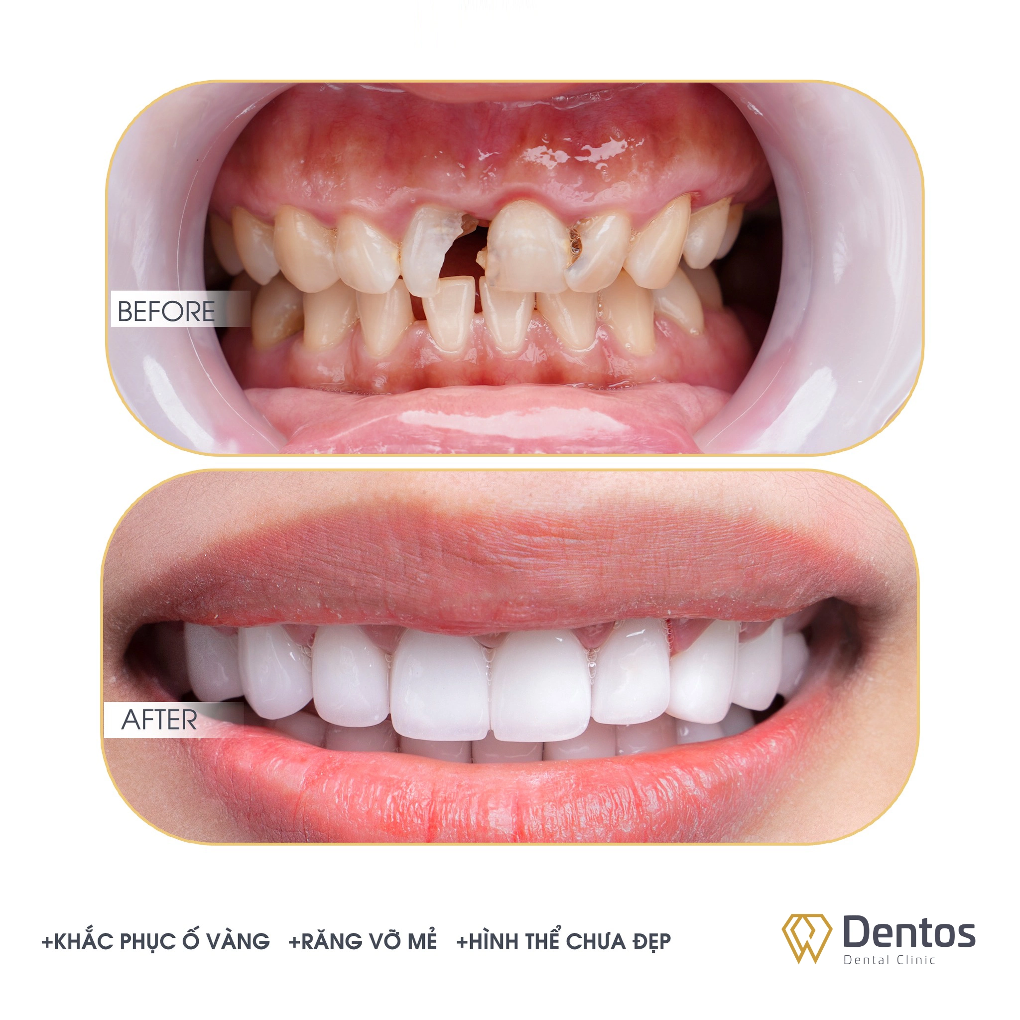 Bọc răng sứ răng cửa là giải pháp hiệu quả khi răng bạn bị mẻ, vỡ lớn